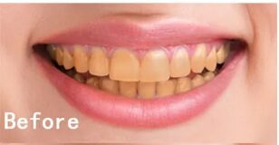 tooth whitening kits.