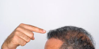 top hair transplantation in Bangalore
