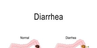 Diarrhea